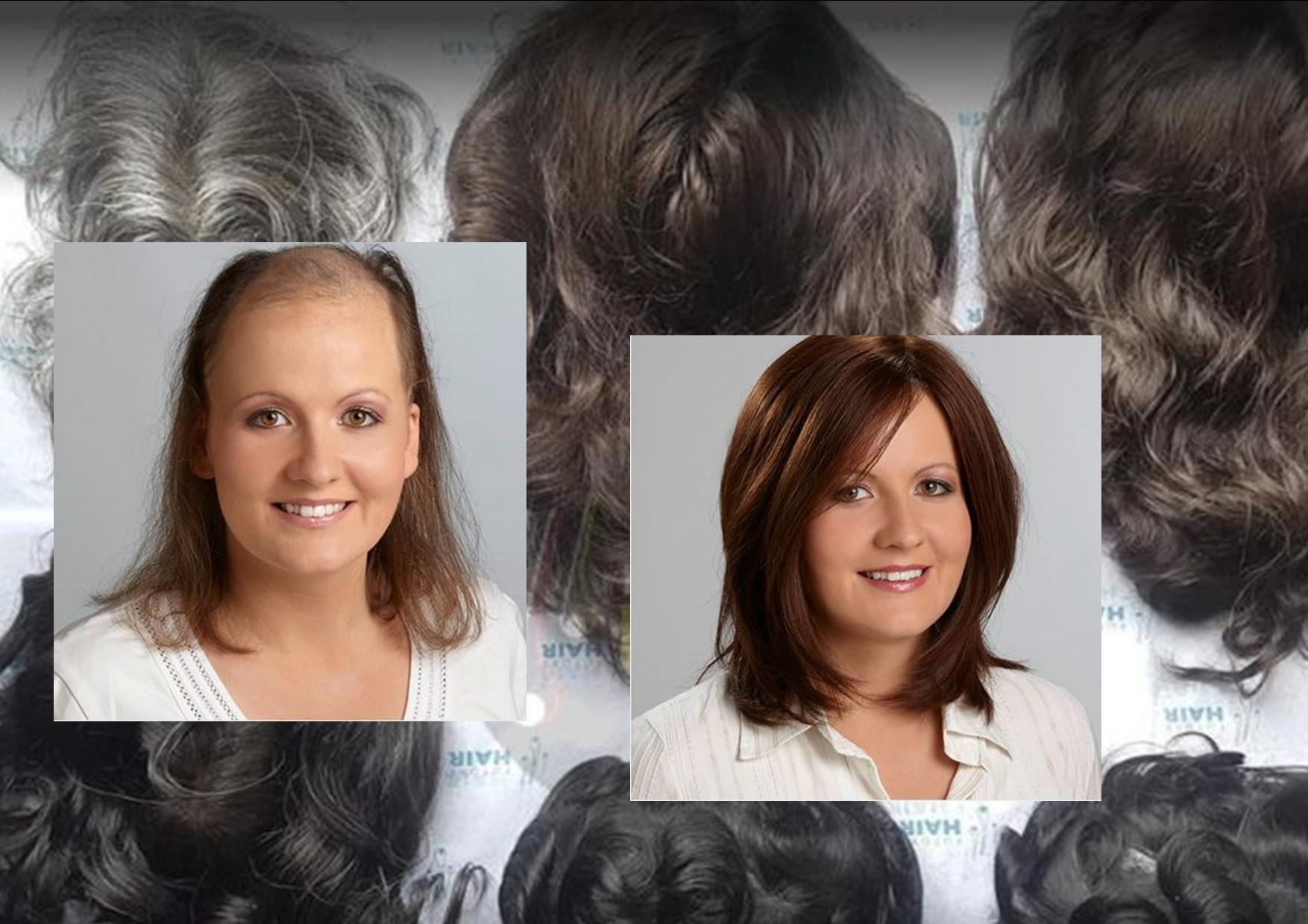 protesi capelli ultima generazione